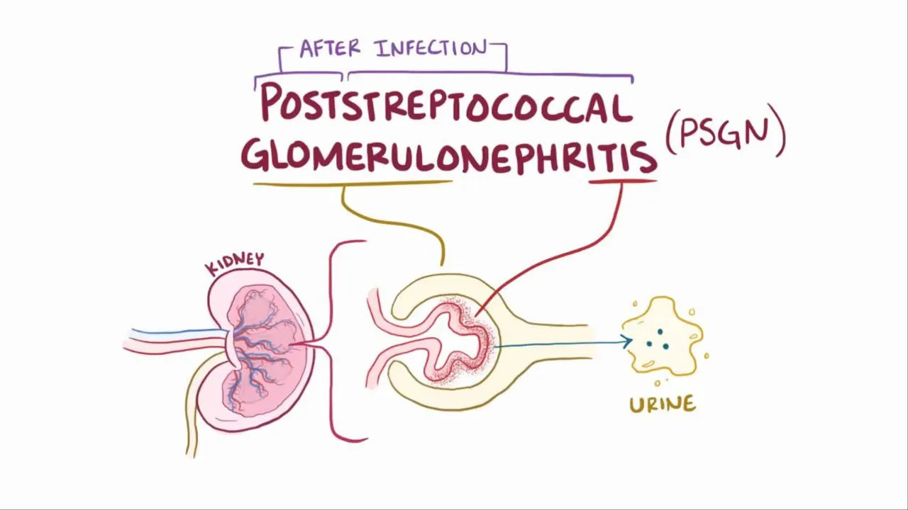 Glomerulonefritis Akut Pasca Streptokokus (GNAPS)